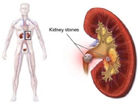 சிறுநீரக் கல் பிரச்னை யாருக்கெல்லாம் வரும் தெரியுமா?