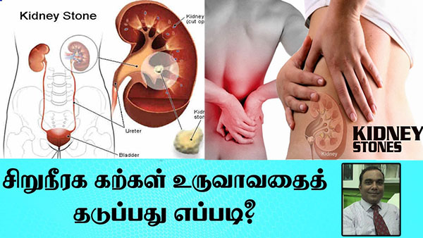 சிறுநீரக கற்கள் – அறிந்ததும் அறியாததும் :