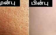 முகத்தில் இருக்கும் குழிகள் மறைய மாட்டீங்குதா? அப்போ இதை பண்ணுங்க