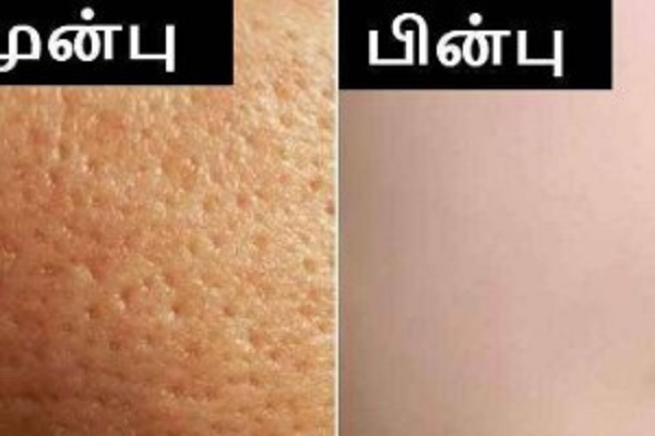 முகத்தில் இருக்கும் குழிகள் மறைய மாட்டீங்குதா? அப்போ இதை பண்ணுங்க