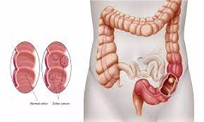 பெருங்குடல் புற்றுநோயை துல்லியமாக குணப்படுத்தலாம்: டாக்டர் பாலமுருகன் விளக்கம்